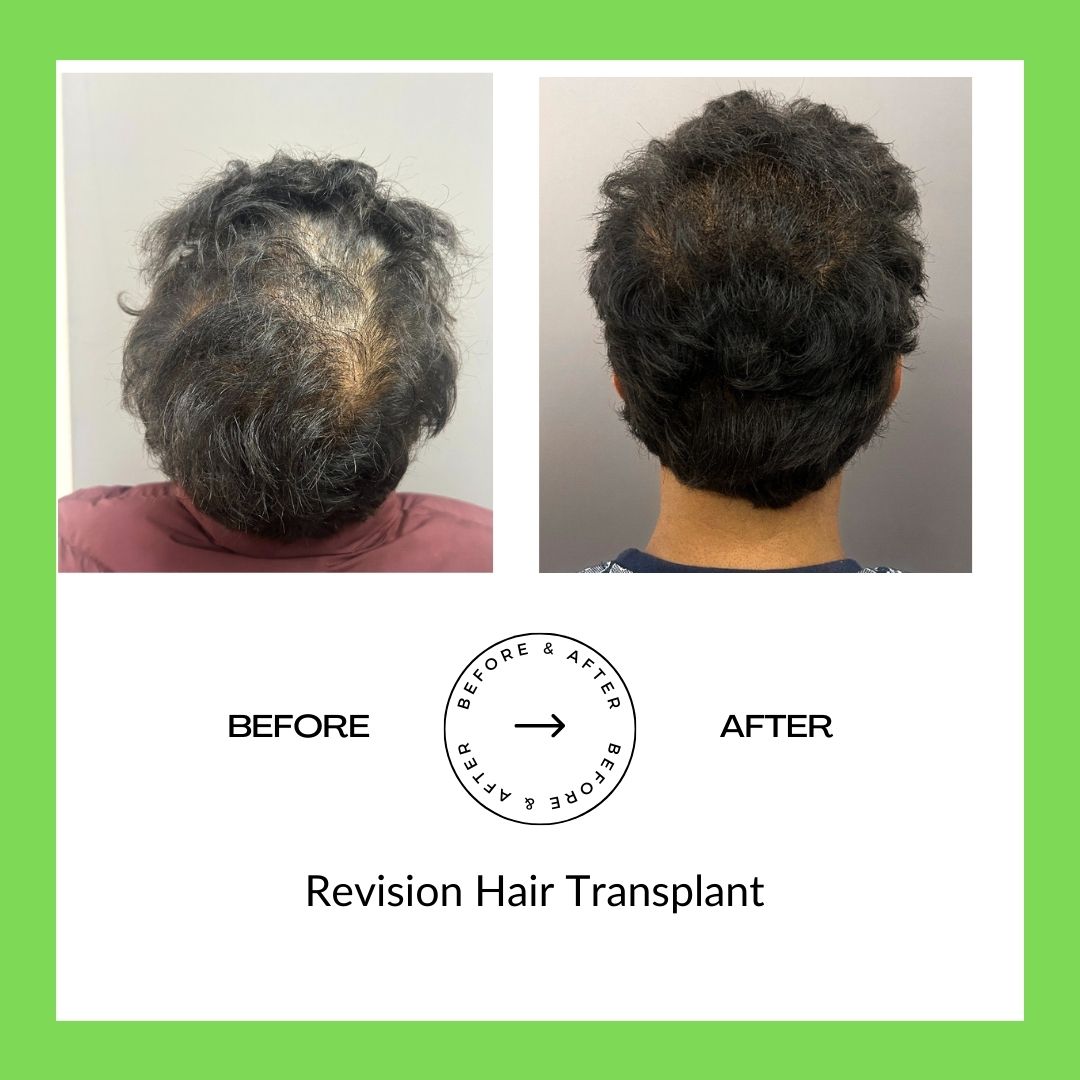 Hair Trasplant Surgery