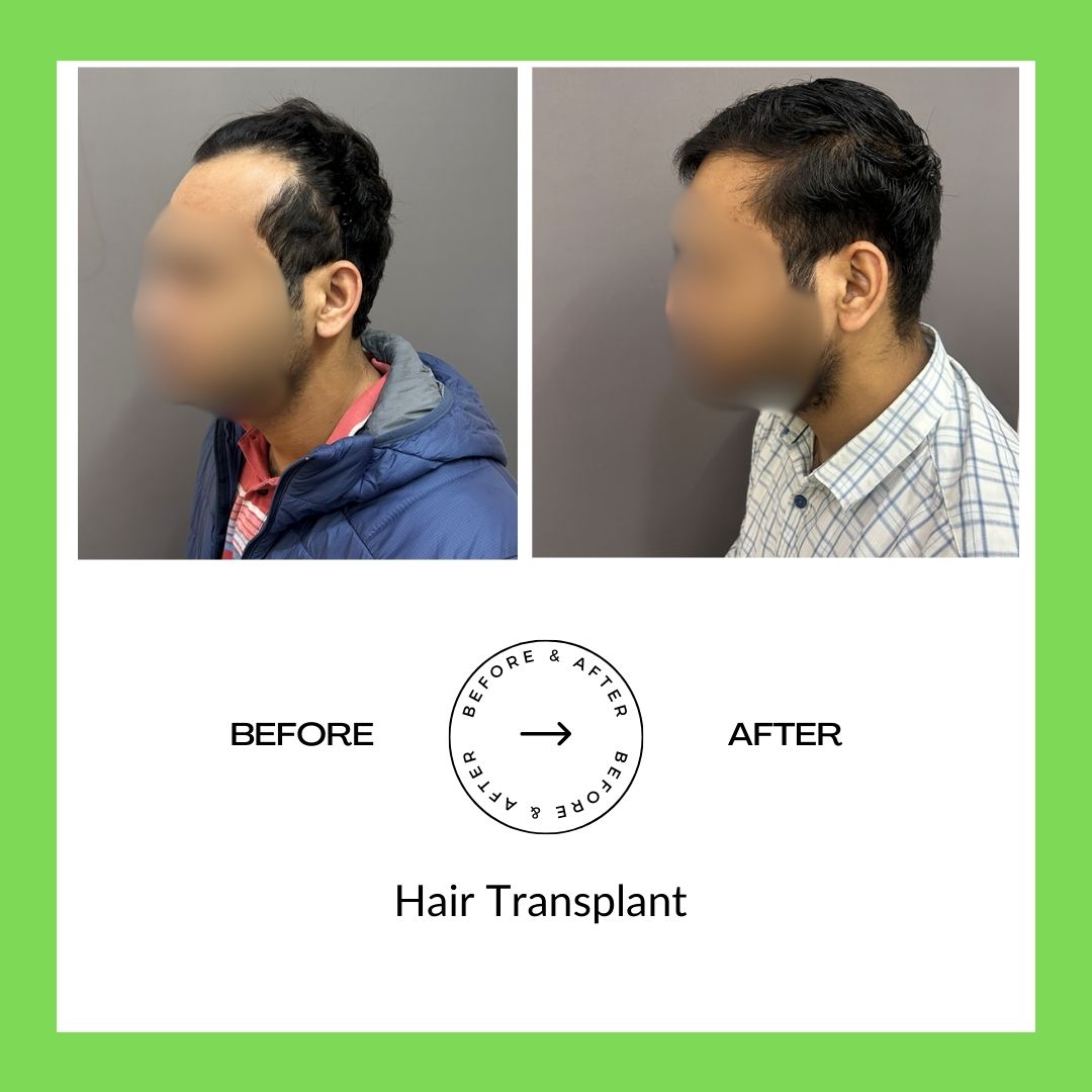 Hair Trasplant Surgery