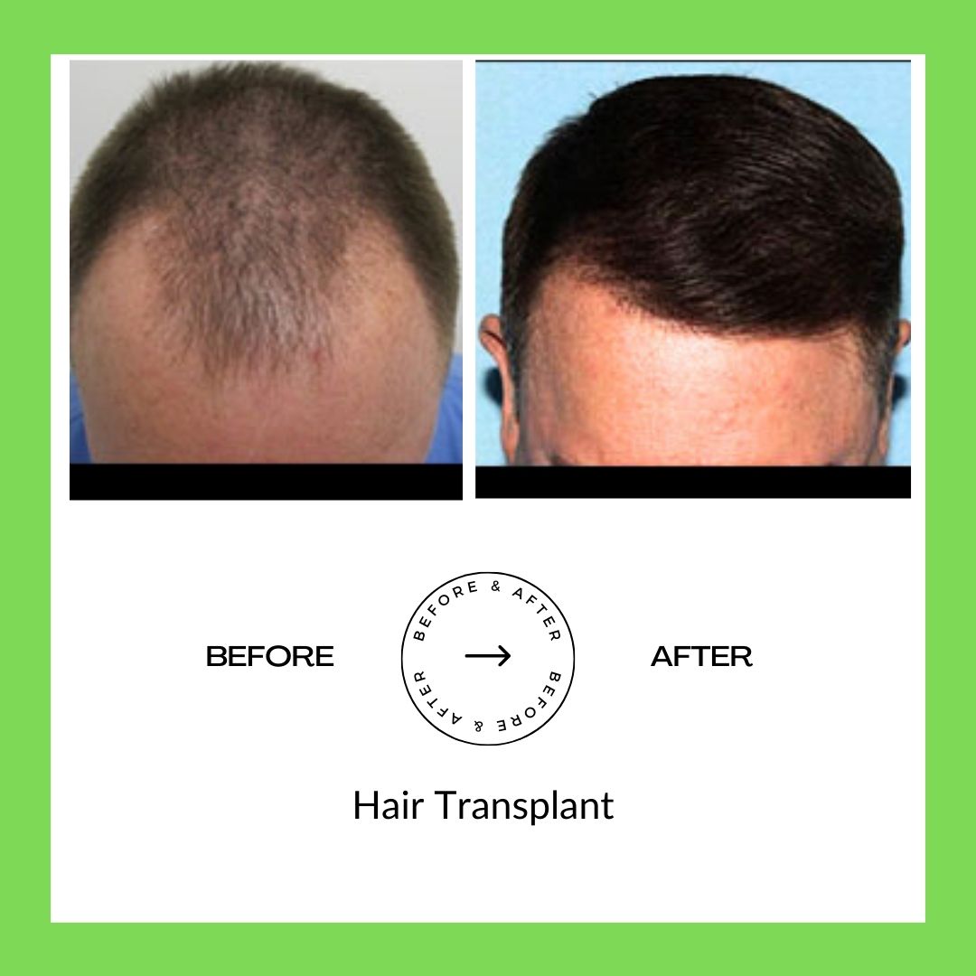 Hair Trasplant Surgery