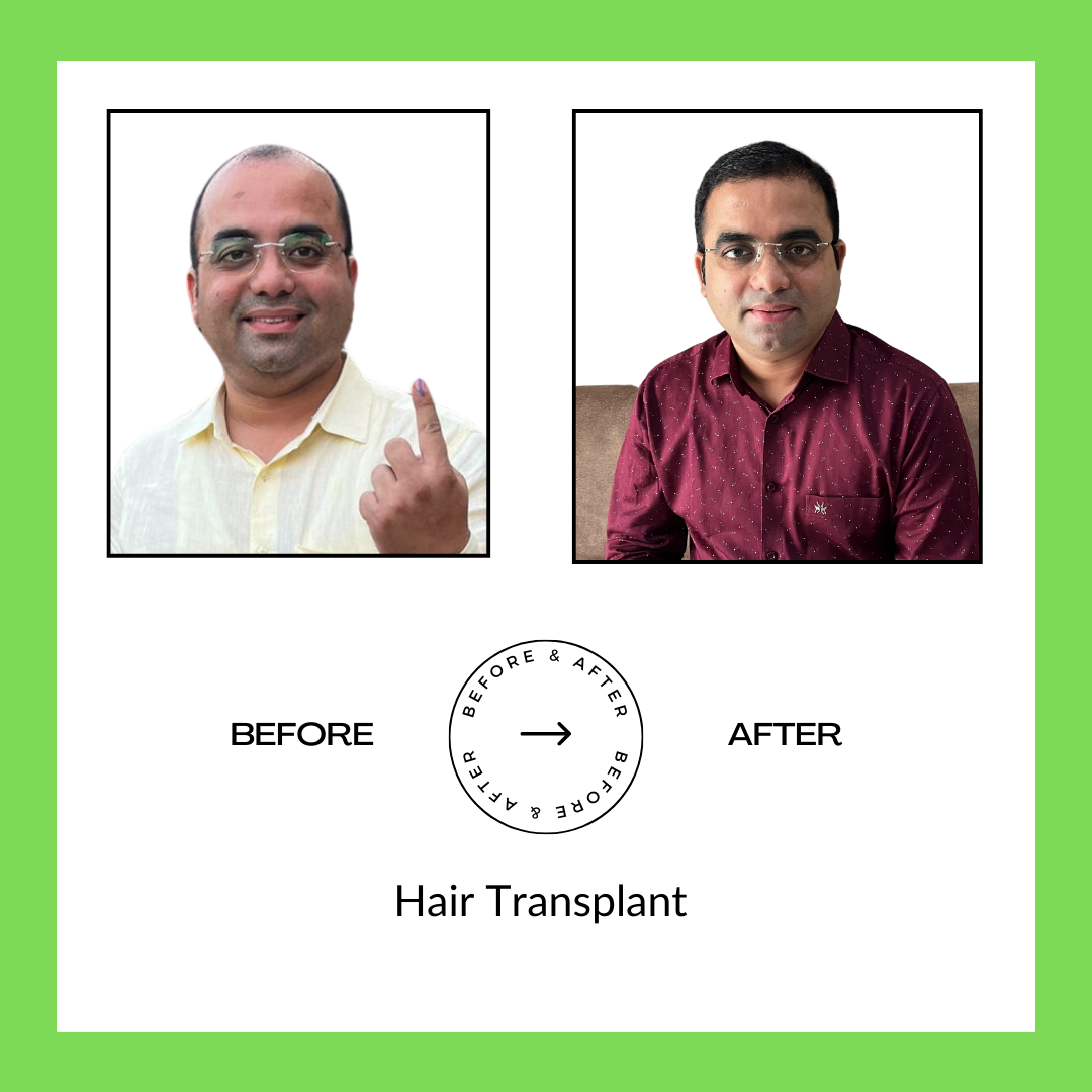 Hair Trasplant Surgery